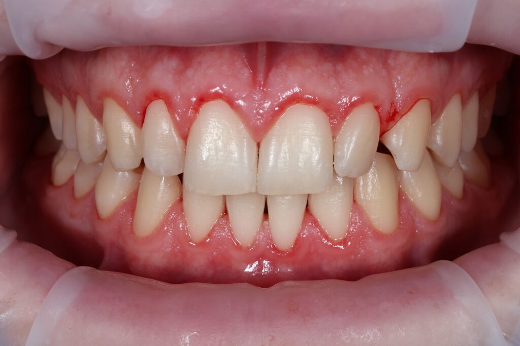 After treatment