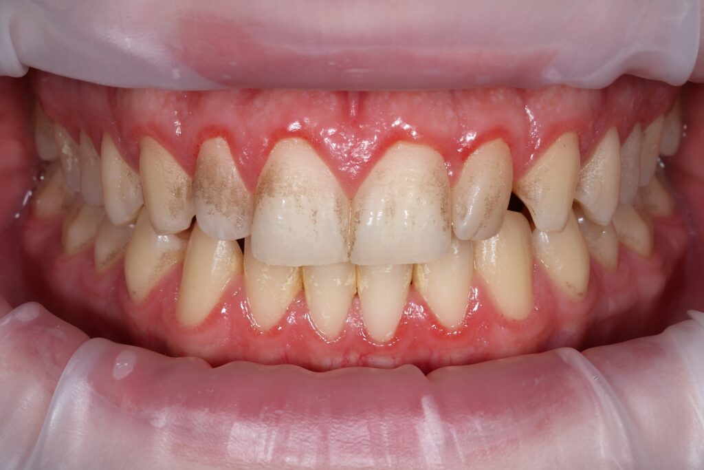 Before treatment