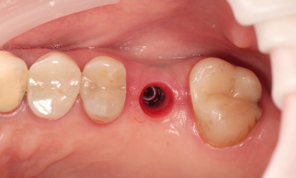 Before treatment