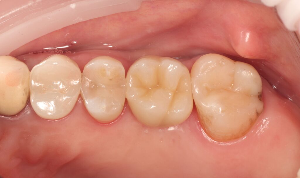 After treatment