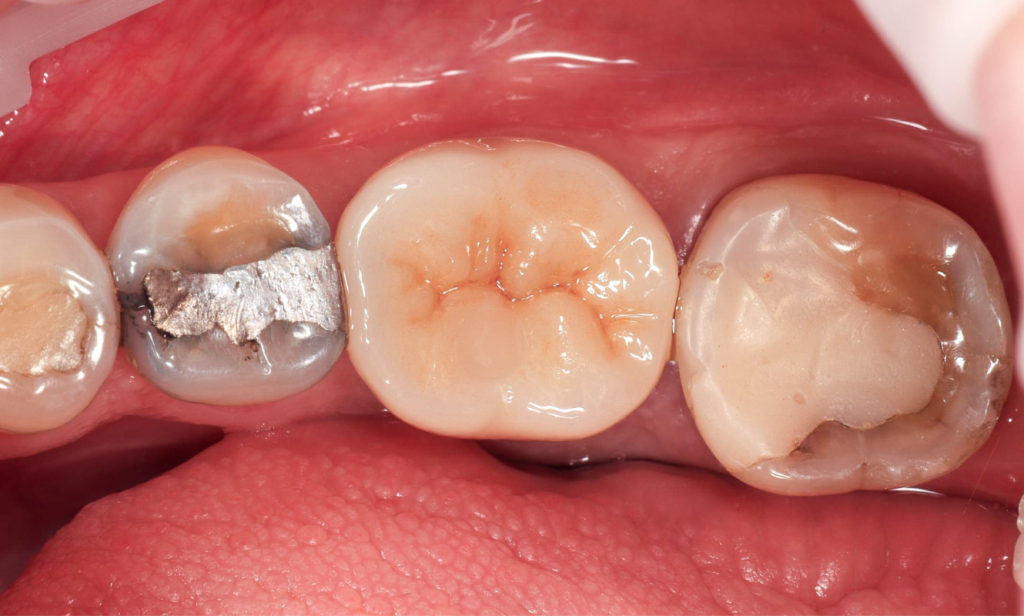After treatment