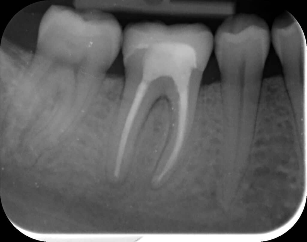 After treatment