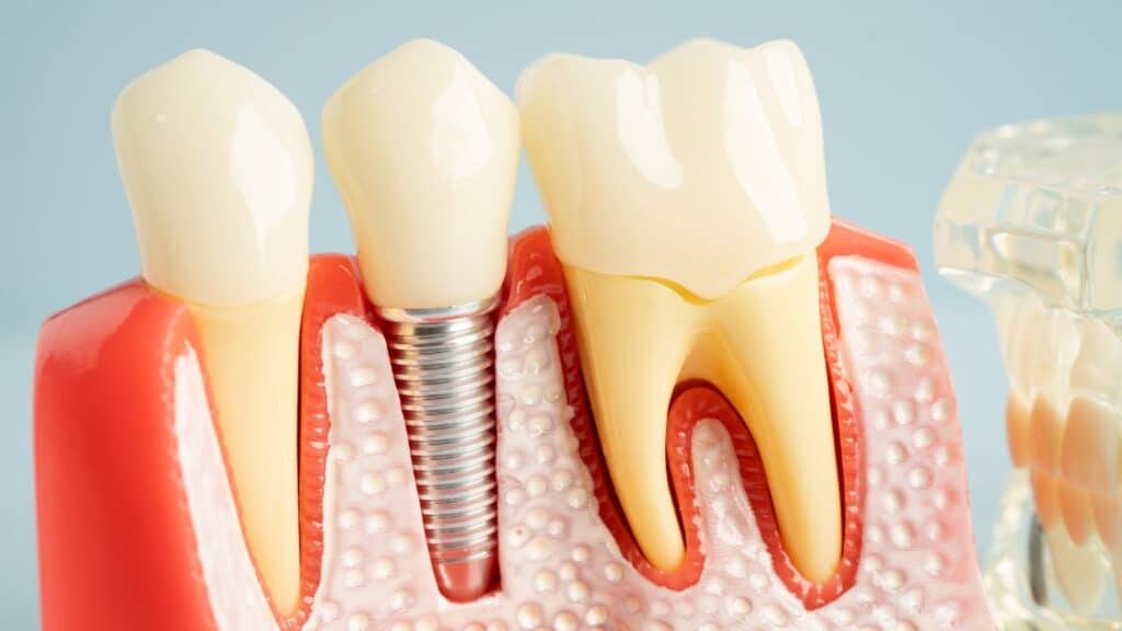 Dental implants