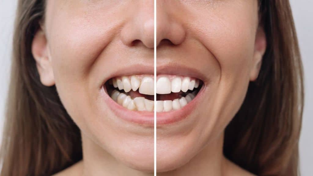 dental veneers smile