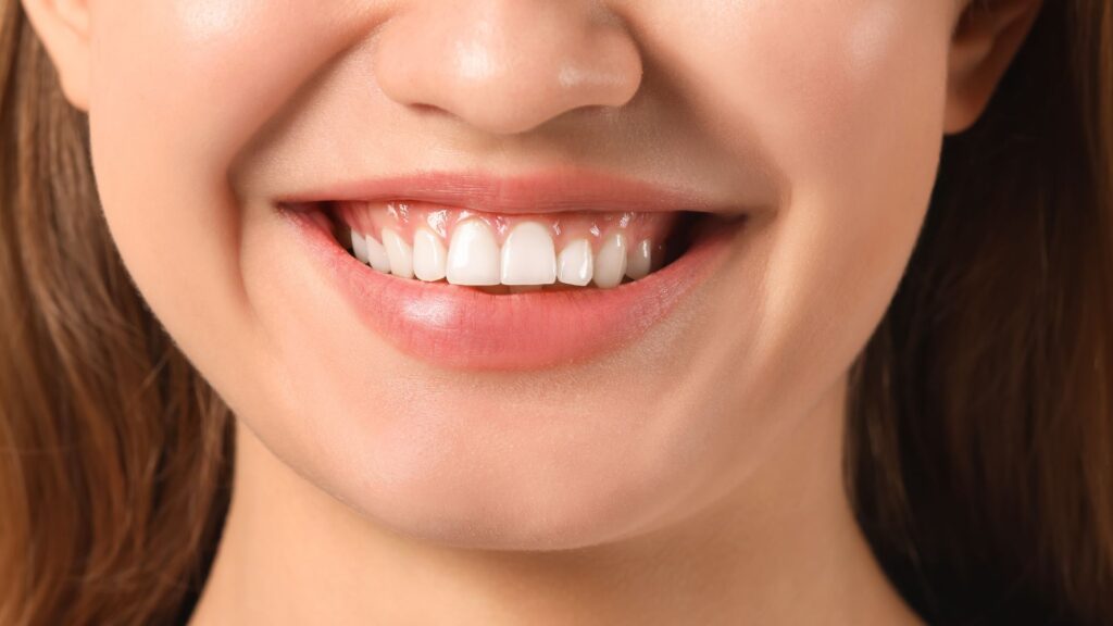 dasnovy usmev gummy smile